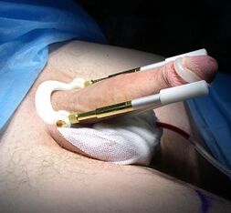 Come viene eseguita un'operazione per aumentare il pene